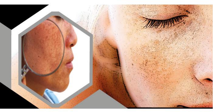 Doğal Olarak Melasma Tedavisi !