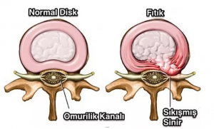 bel fıtıgı teşhisi
