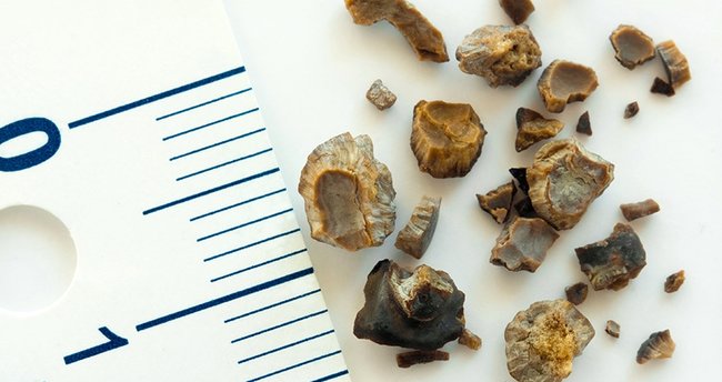 bobrek taşı çeşitleri